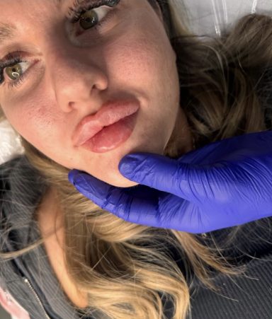 Russian lip filler Lady after lip filler