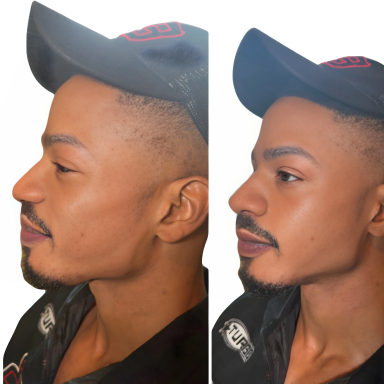 Jaw filler and chin Man after jaw filler