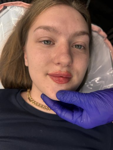 Russian Lips A young women after lip filler