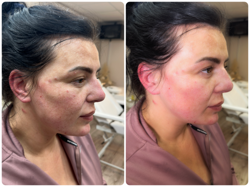 8 point face lift and chin Lady after 8 point face lift/chin before and after