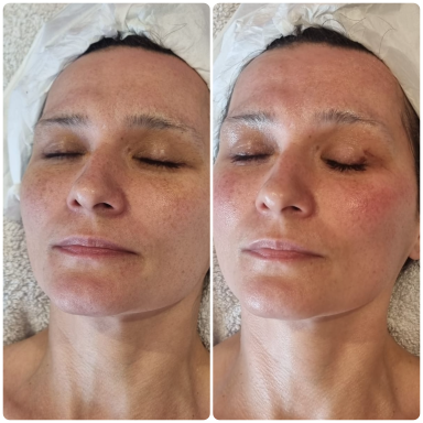 Radio Frequency Facial Lady after radio frequency facial